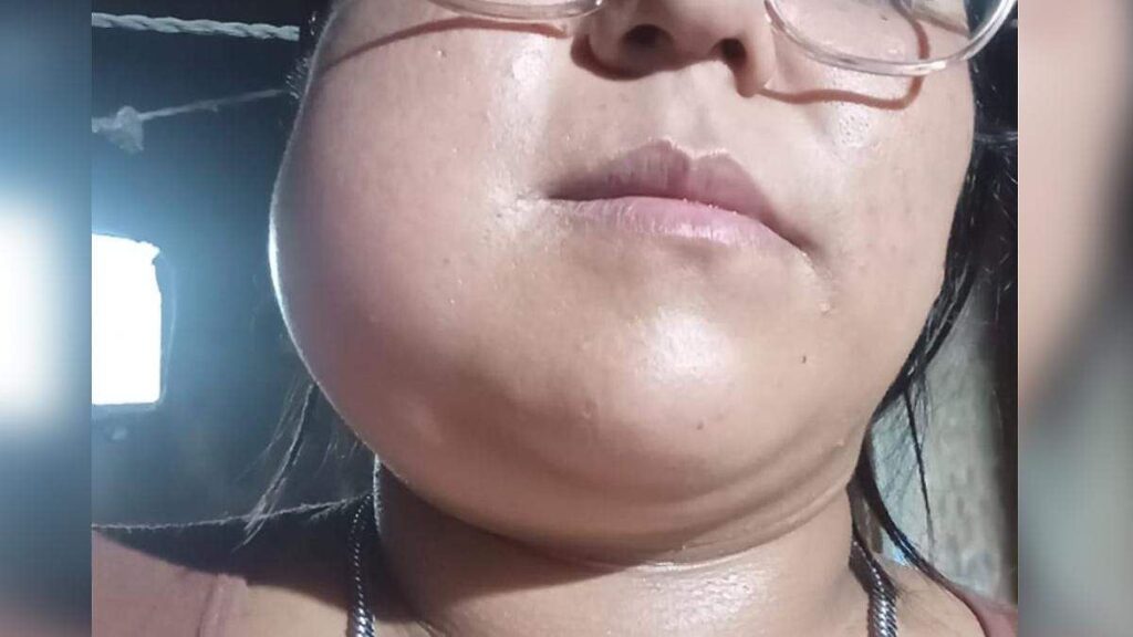 IMSS busca prótesis para Angélica: lleva 2 años esperando cirugía Paciente Angélica espera prótesis mandibular del IMSS Puebla tras dos años de espera para cirugía de tumor